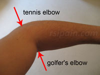 tennis and golfers elbow