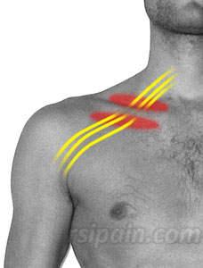 Thoracic outlet syndrome